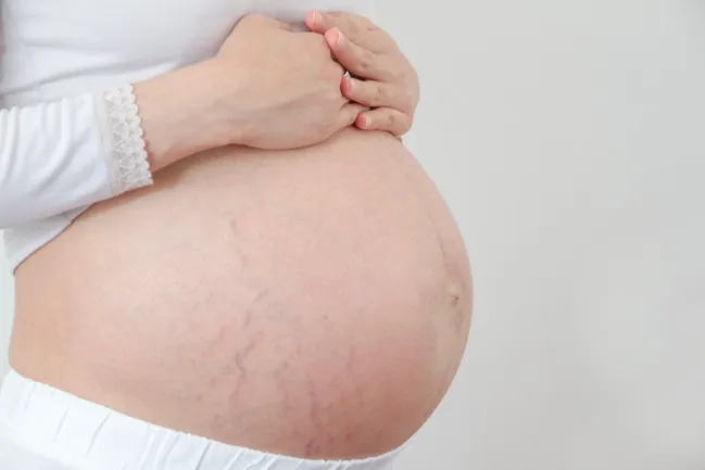 Vergetures et grossesse : comment les éviter et les atténuer ? - Nuoo