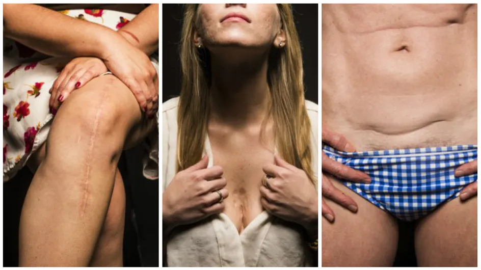Ces 24 guerrières dévoilent leurs cicatrices pour inciter les femmes à s'aimer (Photos)