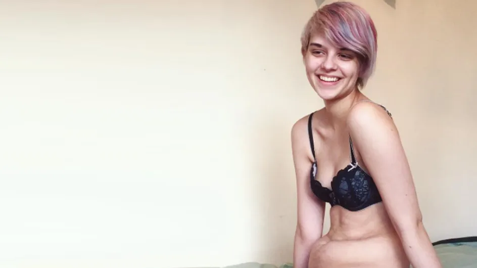 La batalla contra la anorexia de una joven que está inspirando Instagram