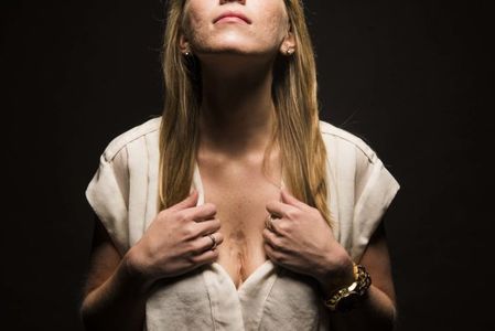 Amanda, 26 años. Tuvo una erupción cutánea agravada por la psoriasis.