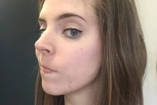 Before treatment