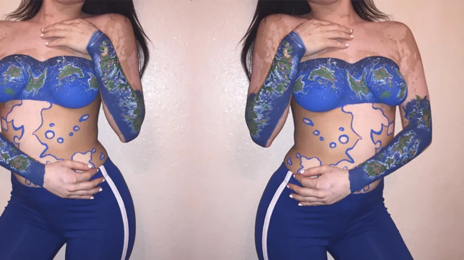 This Woman With Vitiligo Claps Back At Bullies By Turning Her Skin Into A Work Of Art