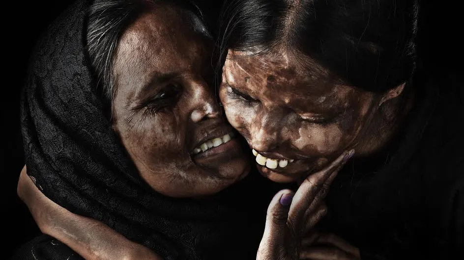 Ce photographe met en lumière la beauté de femmes victimes d'attaques à l'acide (photos)