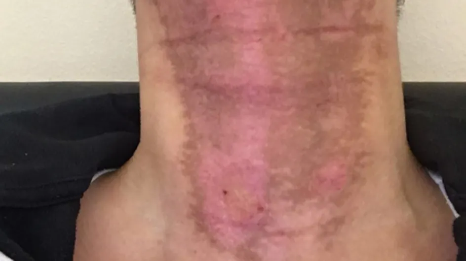 This Woman Mixed Essential Oils With A Sunbed And Suffered Third-degree Burns