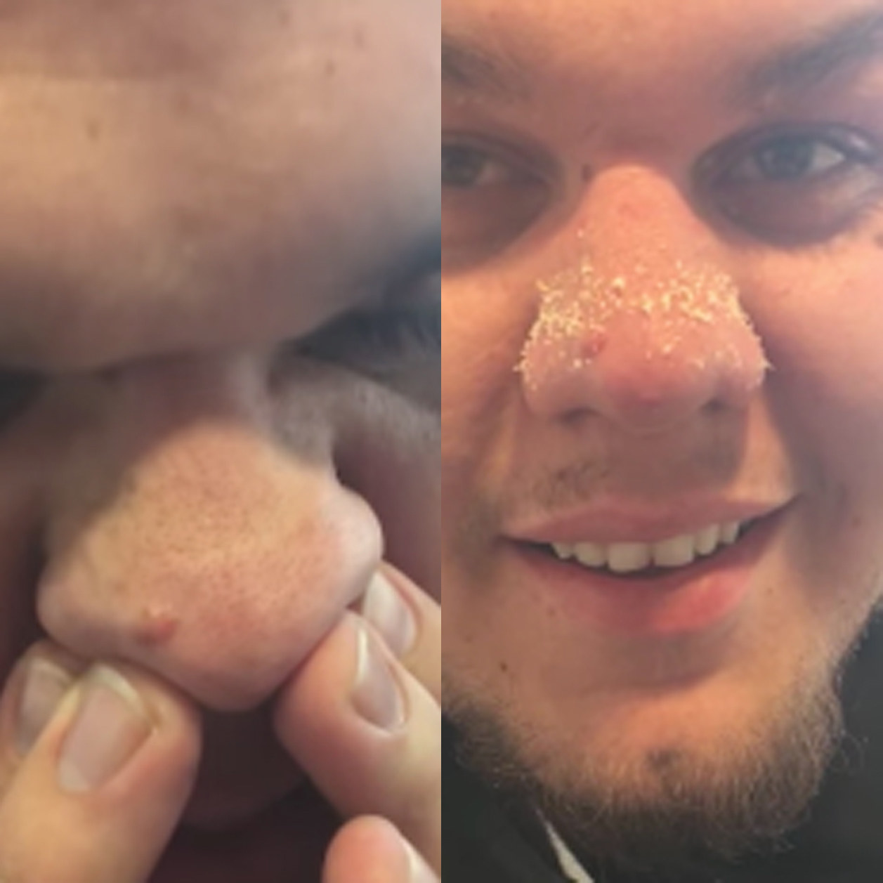 This Guy's Gross Blackhead Is Nothing Short