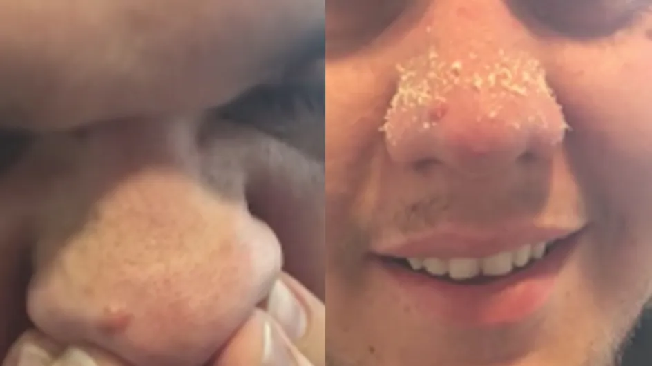 This Guy's Gross Blackhead Removal Hack Is Genius