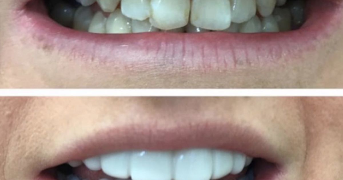 Clip On Teeth Veneers Are Here And They're As Creepy As They Sound