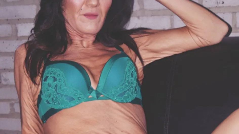 This 26 Year Old With Wrinkles Is Teaching Us To Love Our Bodies