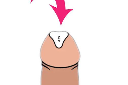 Auf der Penisspitze wird der Sticker aufgeklebt.