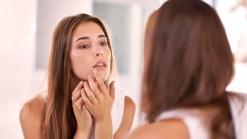 7 falsos mitos sobre el acné que deberías saber