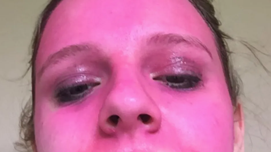 Woman's Face Stained Pink After Applying 'Washable' Glitter Paint