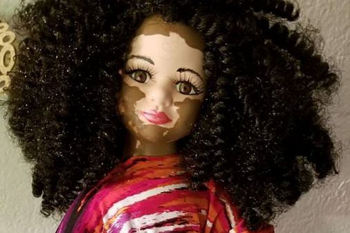 Muñeca con vitíligo