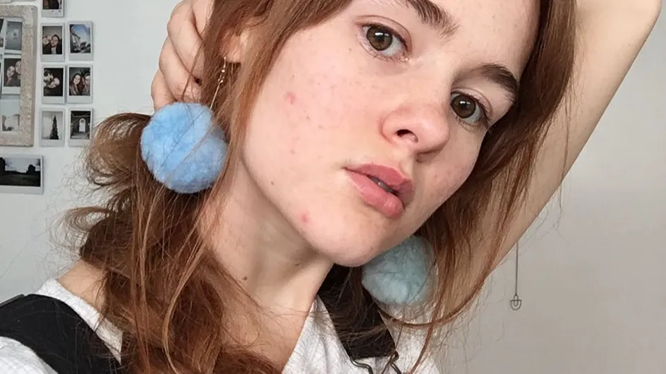 Mira el poderoso mensaje de autoestima de esta joven con acné severo