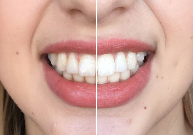 Der Grosse Zahnbleaching Test 5 Produkte Fur Strahlend Weisse Zahne