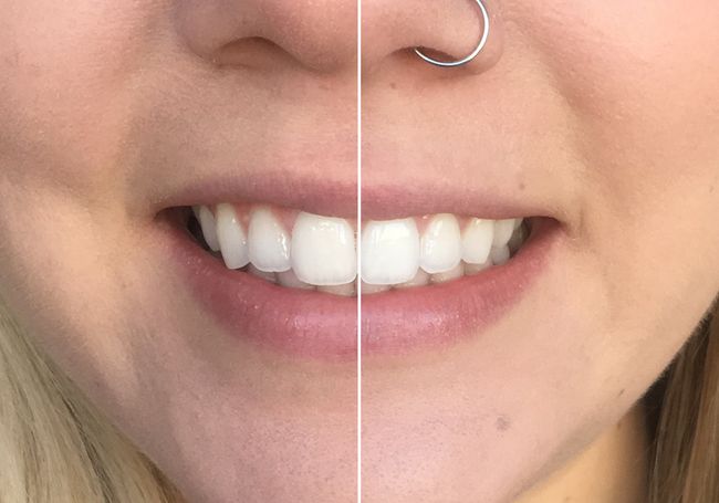 Der Grosse Zahnbleaching Test 5 Produkte Fur Strahlend Weisse Zahne