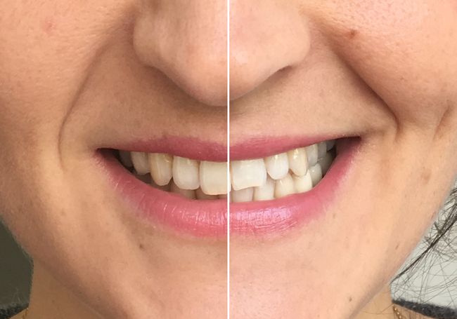 Der Grosse Zahnbleaching Test 5 Produkte Fur Strahlend Weisse Zahne