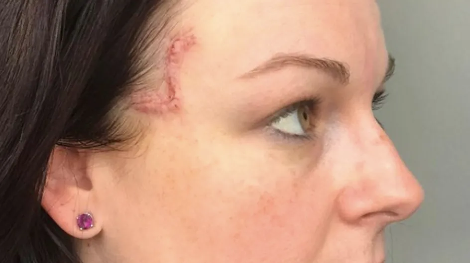 Une tache sur son visage se transforme en cancer de la peau (Photos)