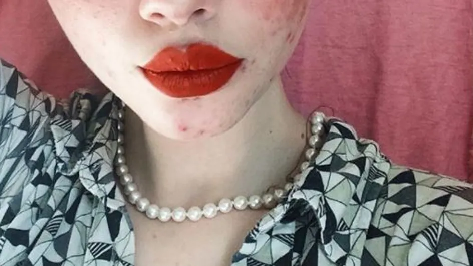 Cette Instagrameuse assume son acné et nous décomplexe ! (photos)