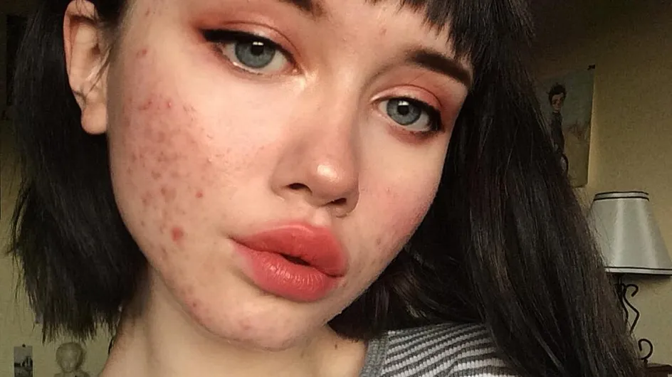 Esta instagramer muestra su acné para luchar contra los estereotipos de belleza