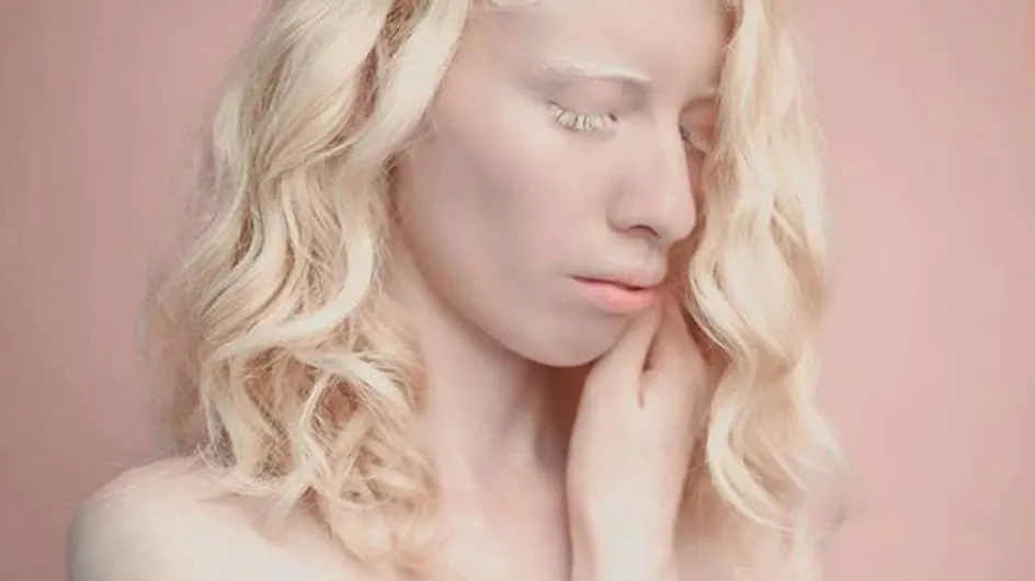 "Je suis fière de ce que je suis", cette jeune albinos change les standards de beauté