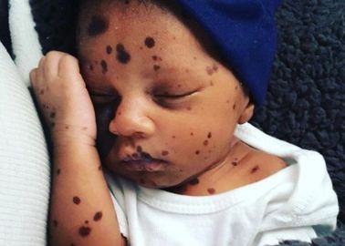 L Emouvante Lettre D Une Maman A Son Bebe Atteint De Naevus Geant