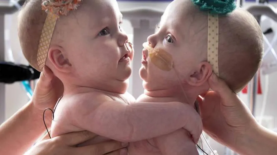 Les photos de ces jumelles partageant le même coeur sont incroyables