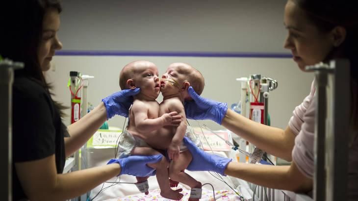 Ces Jumelles Partagent Le Meme Coeur