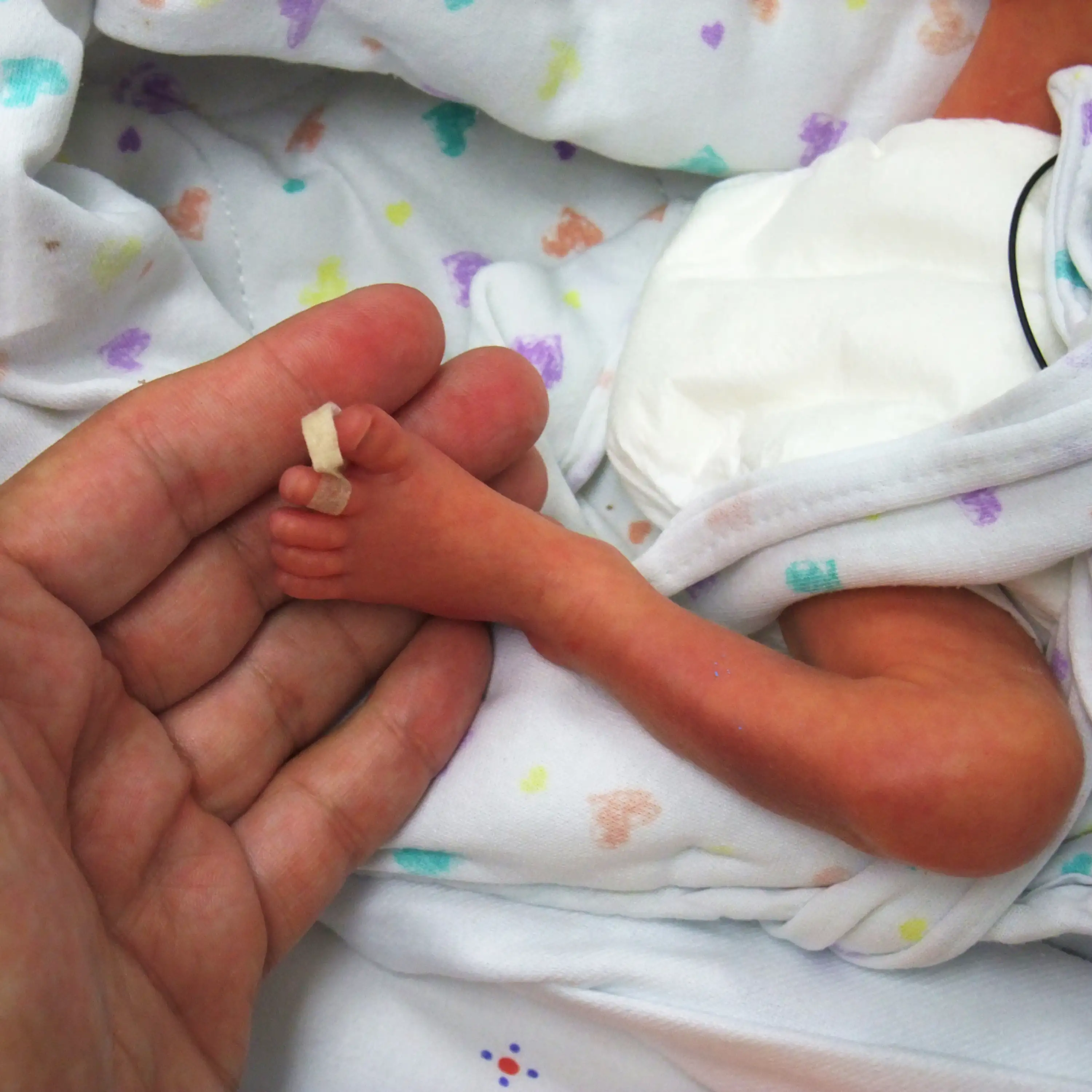 La Peau De Ce Bebe Premature Est Si Fine Que L On Voit Son Cerveau
