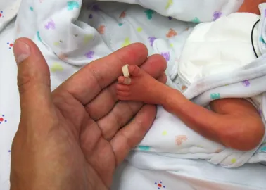 La Peau De Ce Bebe Premature Est Si Fine Que L On Voit Son Cerveau