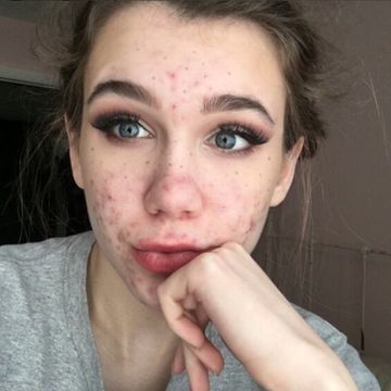 3 Raisons INDISCUTABLES de ne pas utiliser la biafine pour traiter votre  acné - Skin Campus