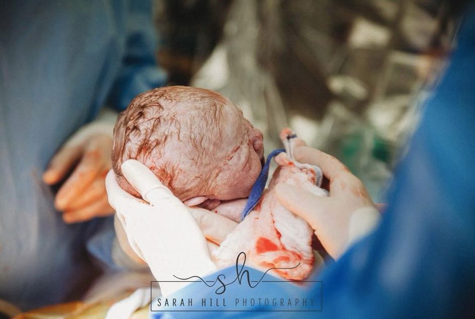 En Pleine Cesarienne Elle Sort Elle Meme Son Bebe De Son Ventre