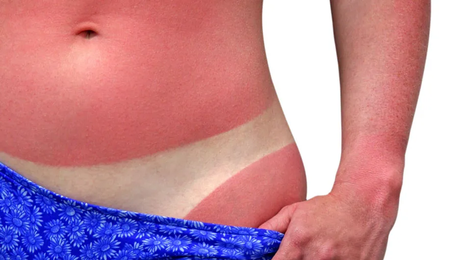 Sunburn treatment | After sun skin care