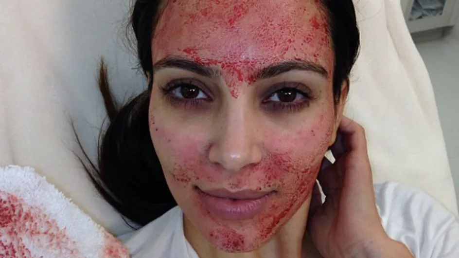 PRP injections: The Kim Kardashian blood facial