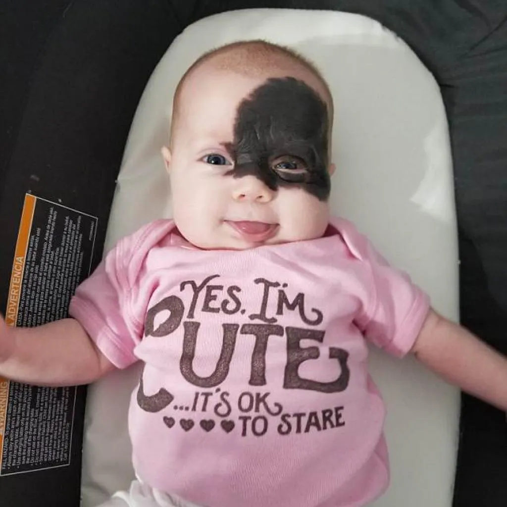 Ce Bebe Nait Avec Une Enorme Tache De Naissance Noire Sur Le Visage