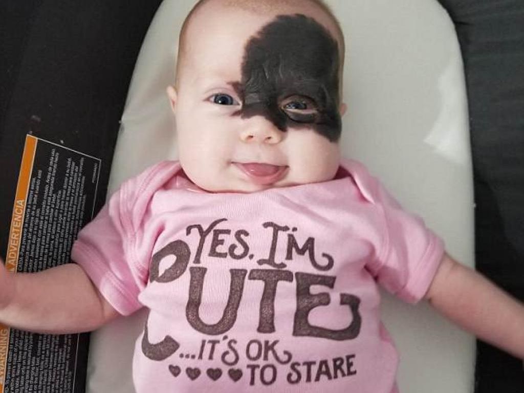 Ce Bebe Nait Avec Une Enorme Tache De Naissance Noire Sur Le Visage