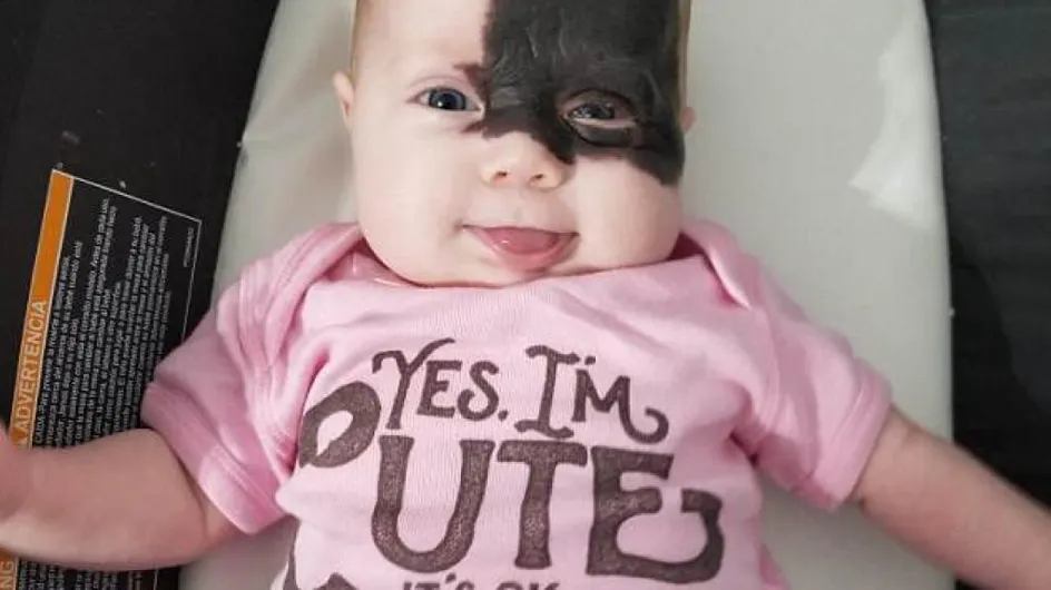Avec sa tache de naissance noire sur le visage, ce bébé est comparé à un super-héros