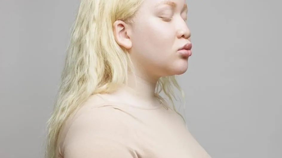 Moquée pendant son enfance, cette femme albinos prend sa revanche en devenant mannequin