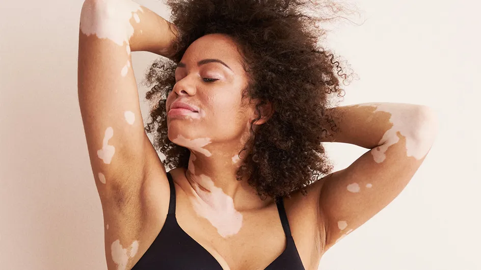 Trisomie, vitiligo... Cette marque de lingerie représente enfin toutes les femmes