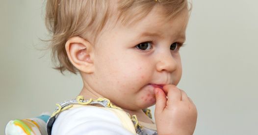 Comment Reconnaitre La Maladie Pieds Mains Bouche Et La Soigner