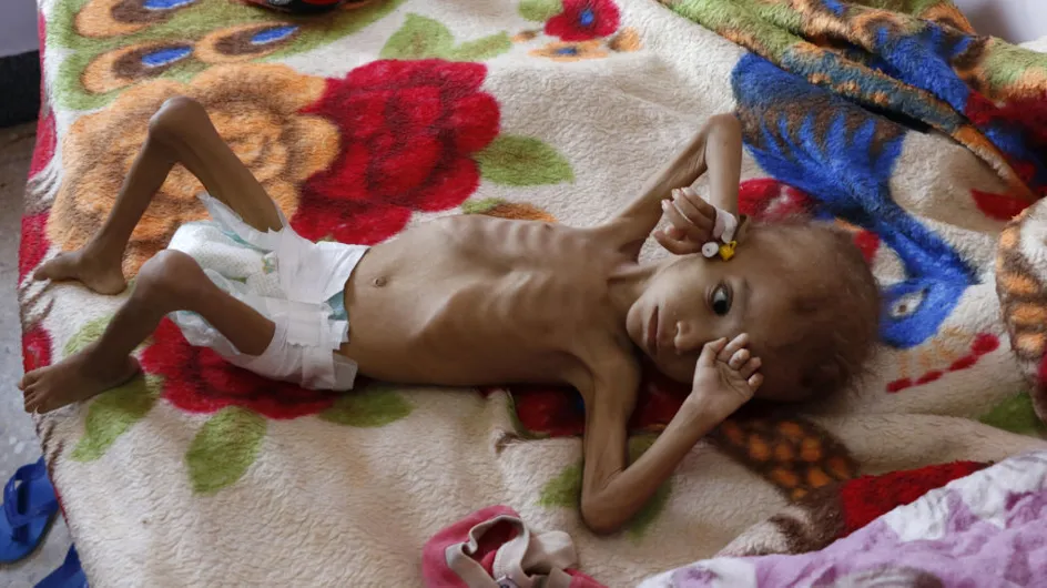 85 000 enfants de moins de 5 ans seraient morts de faim depuis le début de la guerre au Yémen