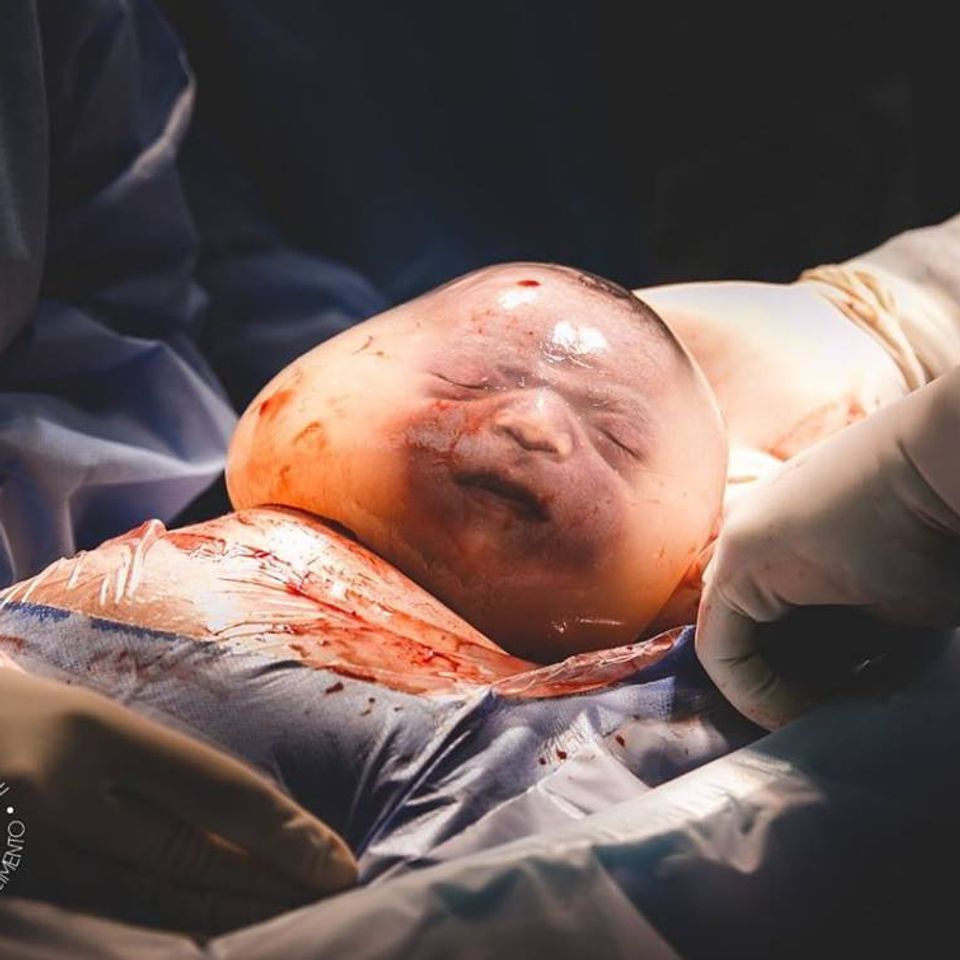 Les photos de ce bébé né dans une bulle sont impressionnantes