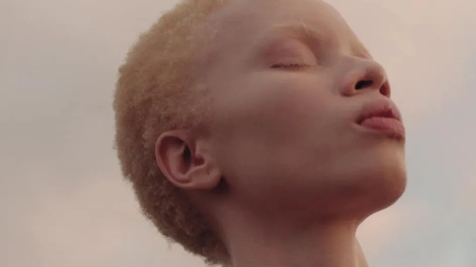 Bravo ! Pour la première fois, Vogue célèbre la différence avec une covergirl albinos