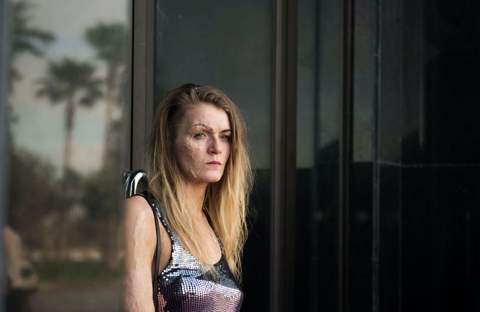Dirty God la reconstruction poignante d’une femme brûlée au visage