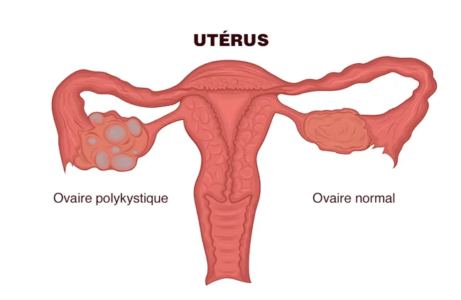 ovaires polykystiques : causes, symptômes et traitement