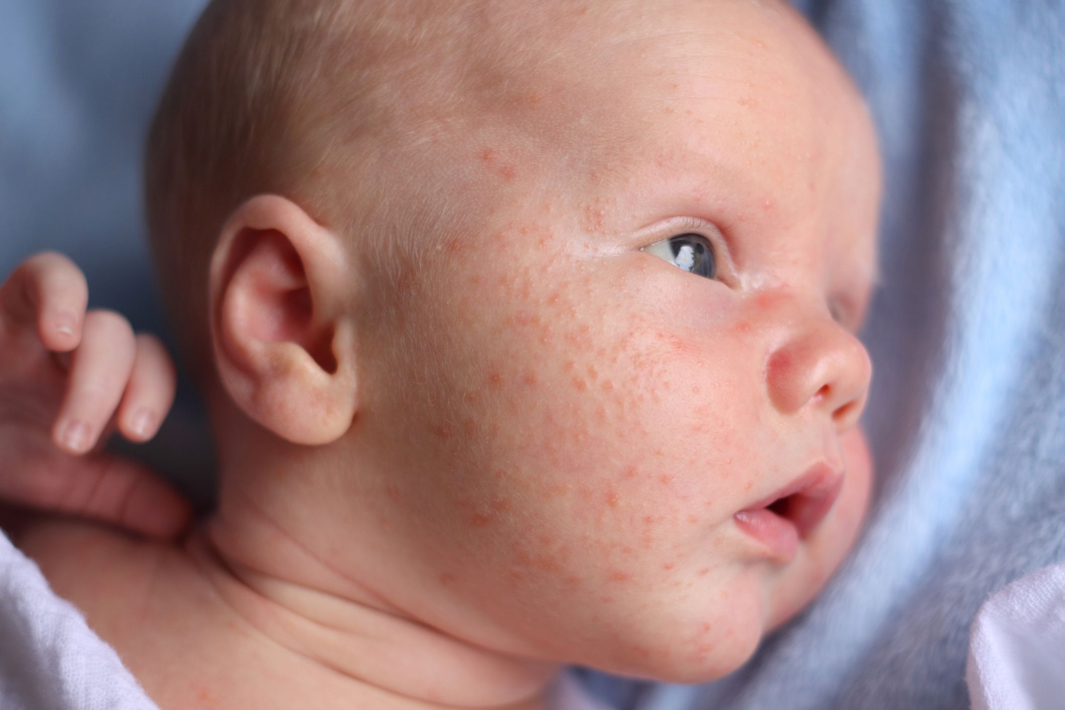 D'où viennent ces boutons d'acné sur le corps de bébé ?