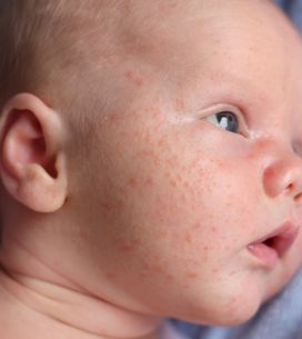 Varicelle Symptomes Boutons Traitements