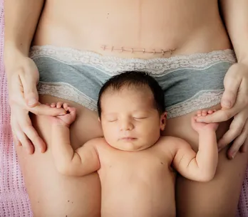 Crema para cicatrices, di adiós a las marcas de tu piel