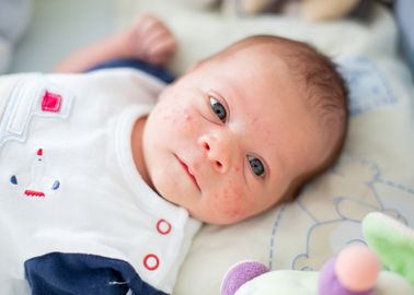 La Roseole Du Bebe Tout Savoir Sur Cette Maladie Infantile