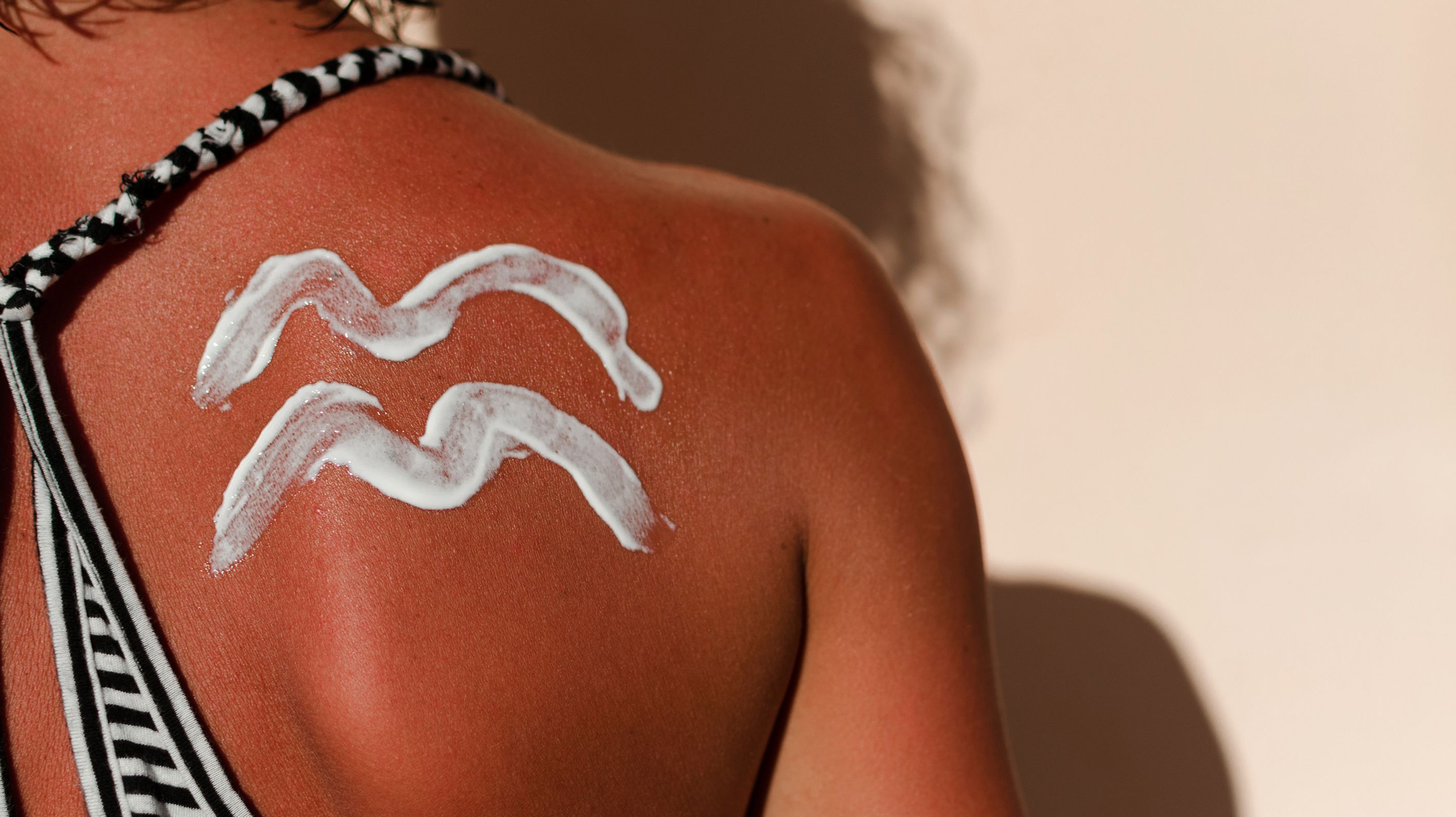Hausmittel gegen Sonnenbrand: Die helfen am besten!