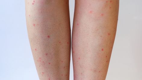 Puntini Rossi Sulle Gambe Sai Perche Compaiono